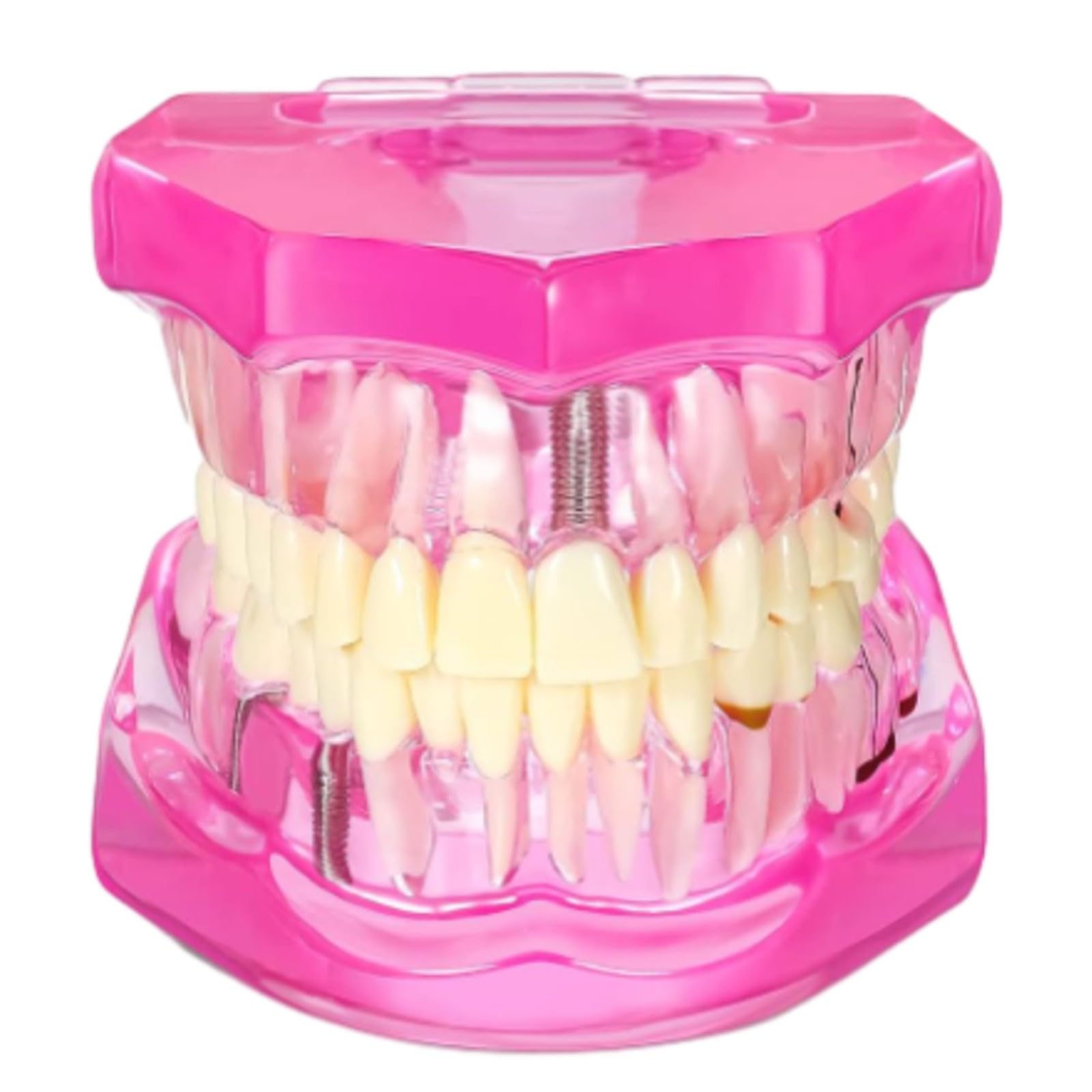 Xiaoxu Modello di Denti patologici, Modello di Denti implantari Trasparenti con Denti Rimovibili per Studio e didattica odontoiatrica.
