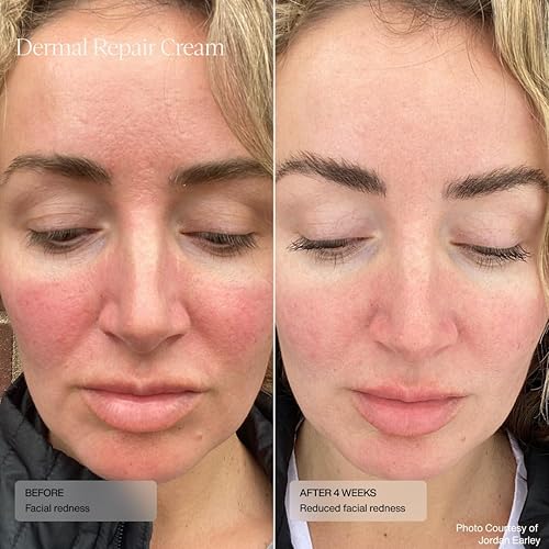 Miniatura 2 de Senté Dermal Repair Crema facial  Nutritiva para rosácea y piel sensible  Hidrata y rejuvenece  con HSA patentada, vitamina E y extracto de té