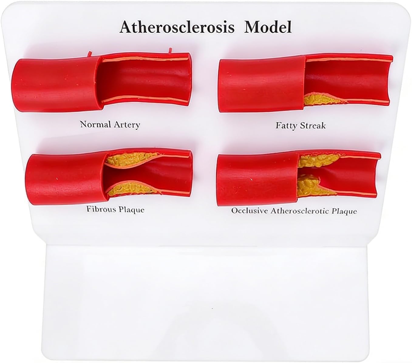 Menschliches Atherosklerosemodell, 4-stufiges pathologisches anatomisches Darstellungsmodell der Arterie, verwendet for medizinische Lehre und Demonstration der Physiologie des