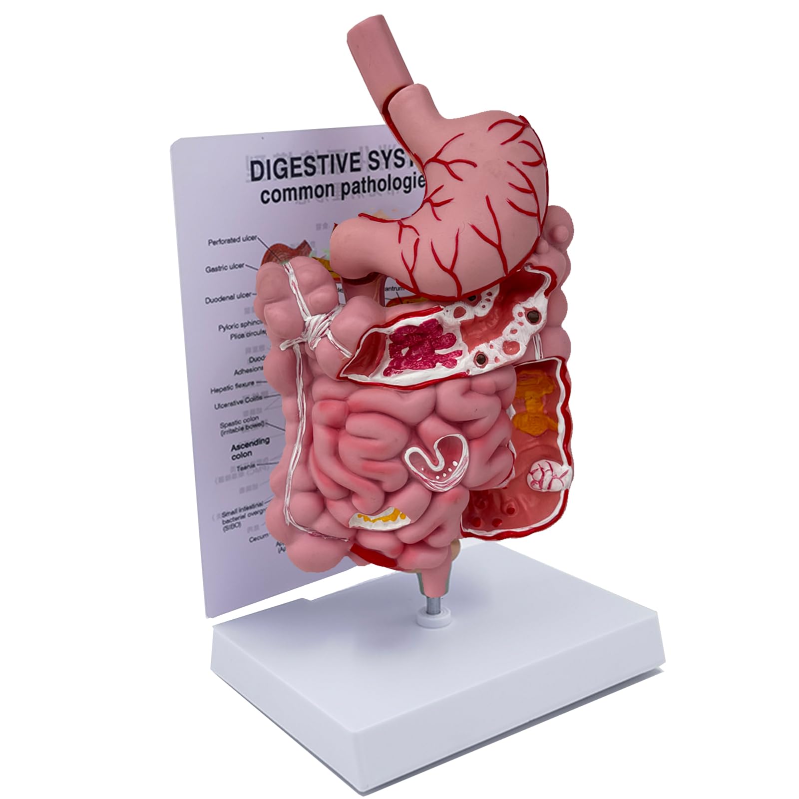 Human Digestive System Model,Removerable Human Stomach Anatomy Model Pathological Digestive System Model Includes GI-Tract and Colon,Includes Product Manual