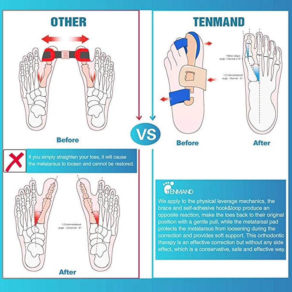 TILEZE 1 Paar Korrektoren und Glätteisen für große Zehen, Schiene zur nächtlichen Linderung von Hallux Valgus Schienen für Frauen und Männer