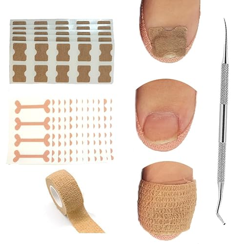 Miniatura 1 de Tratamiento de uñas encarnadas, kit de eliminación de uñas encarnadas, 50 calcomanías de corrección de uñas encarnadas, 50 parches correctores de