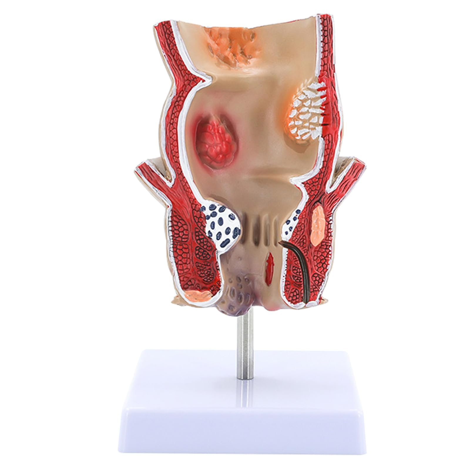 Xiaoxu Modèle de Rectum pour travaux Pratiques en Anatomie Humaine : Pathologies du Rectum, Outil pédagogique en Anatomie.
