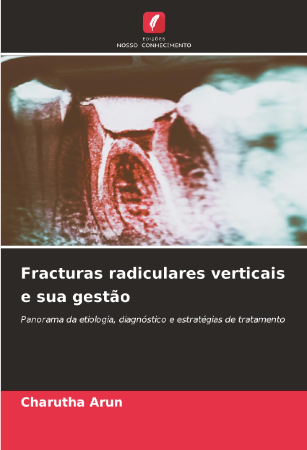 Fracturas radiculares verticais e sua gestão: Panorama da etiologia, diagnóstico e estratégias de tratamento