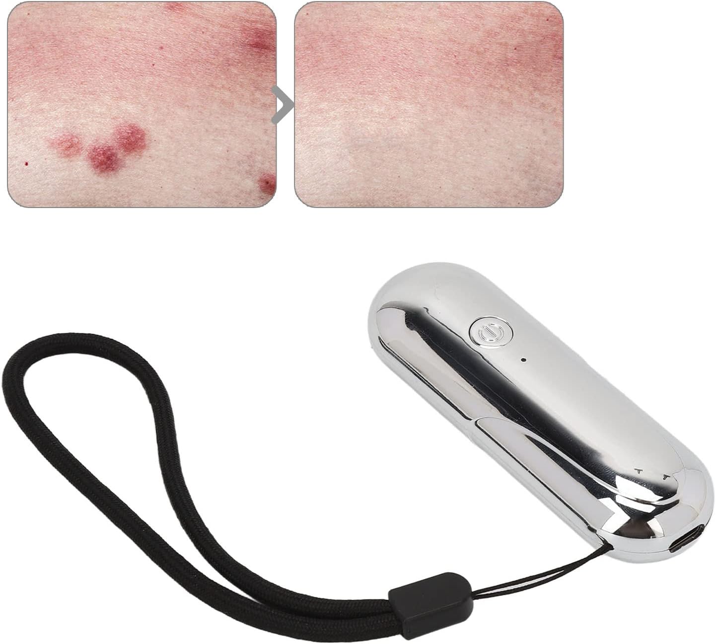 Electronic and insects Bite Pin,insects Bite Healer Itch Inhibiting