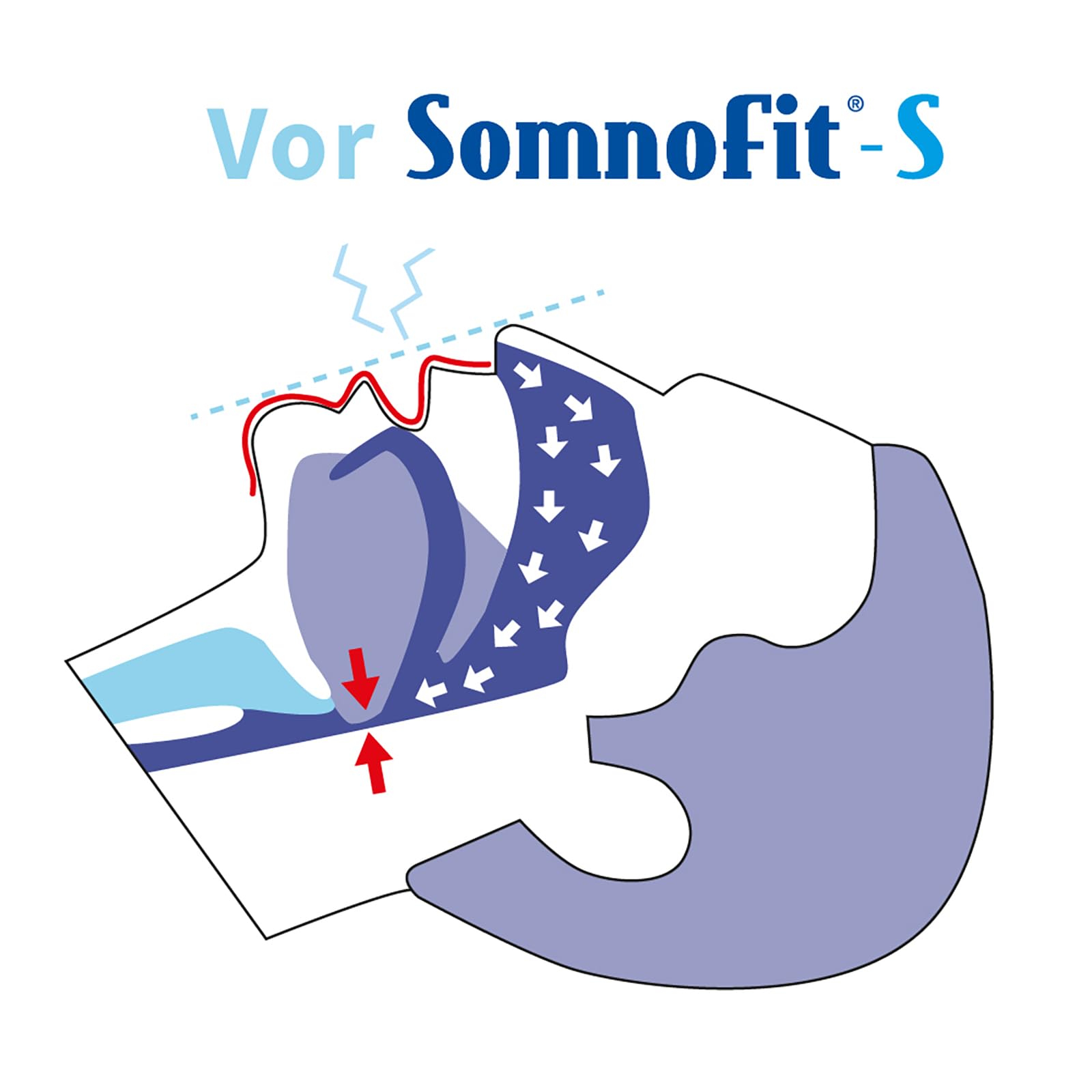 Schnarchstopper Somnofit-S - Anti-Schnarchschiene (SomniShop-Set mit Ratgeber)