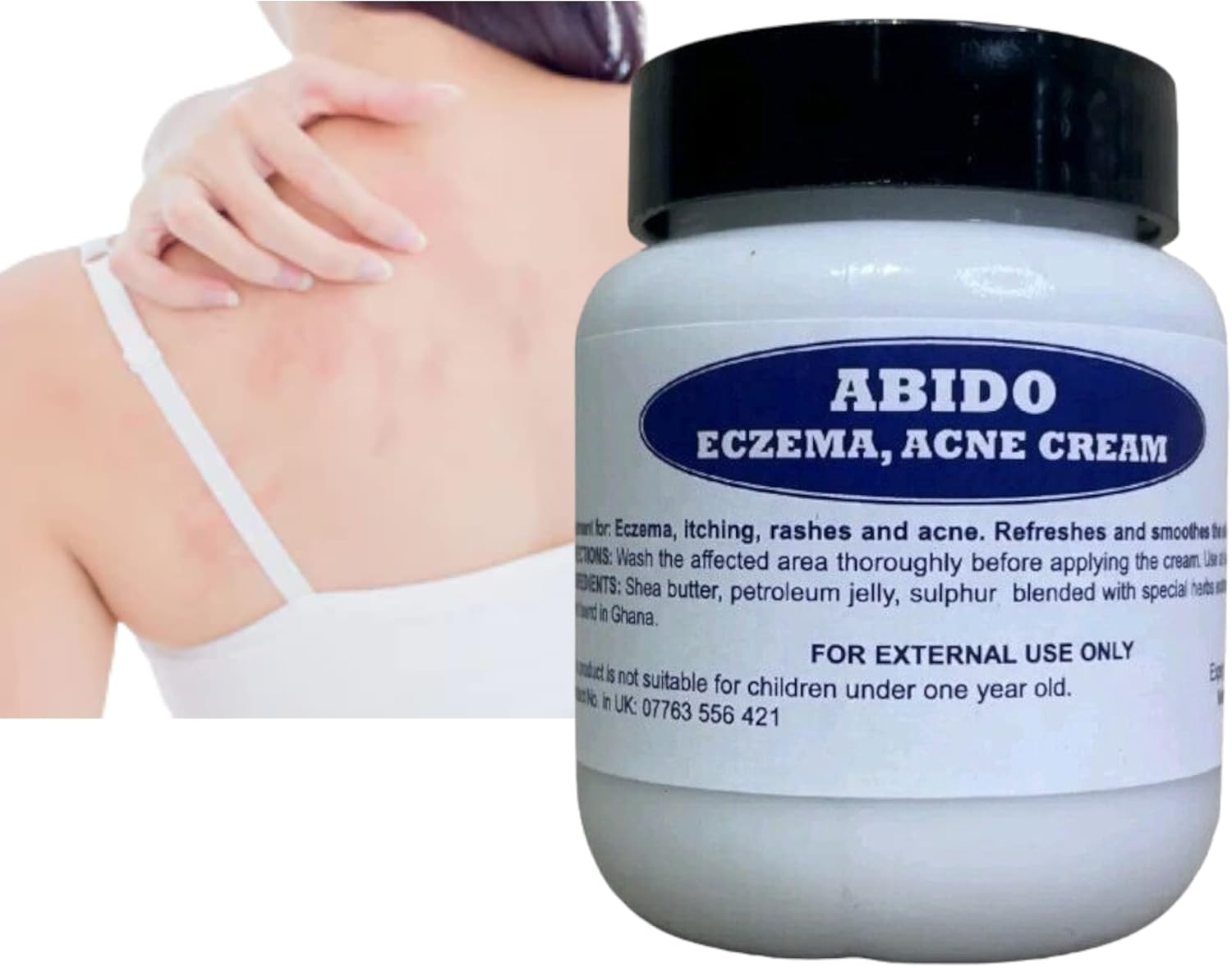 Alvies® abd Herbal Antibacterial Cream, Anti-itch Relief Eczema Skin ...