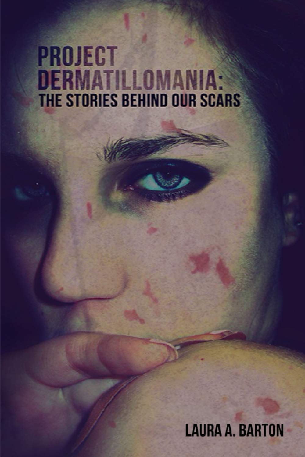 Project Dermatillomania: The Stories Behind Our Scars