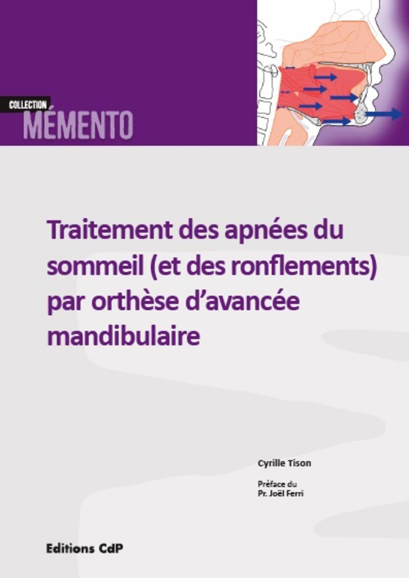Traitement des apnées du sommeil (et des ronflements) par orthèse d'avancée mandibulaire