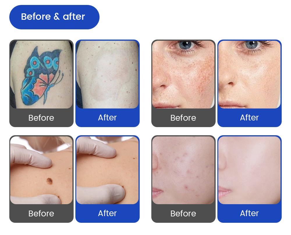 16 barre Epilazione laser 2 in 1 Rimozione tatuaggi con laser Pico | 755nm/808nm/940nm/1064nm Rimozione di macchie cutanee, rimozione di cicatrici da acne, rimozione di nei