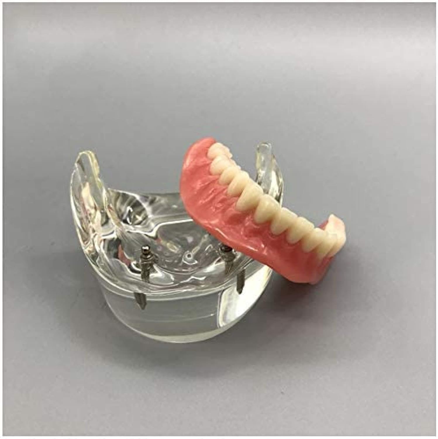 Modello Dentale - Impianto Dentale - Overdenture Inferiore Mandibolare 2 Impianti Demo Per L'insegnamento E Lo Studio