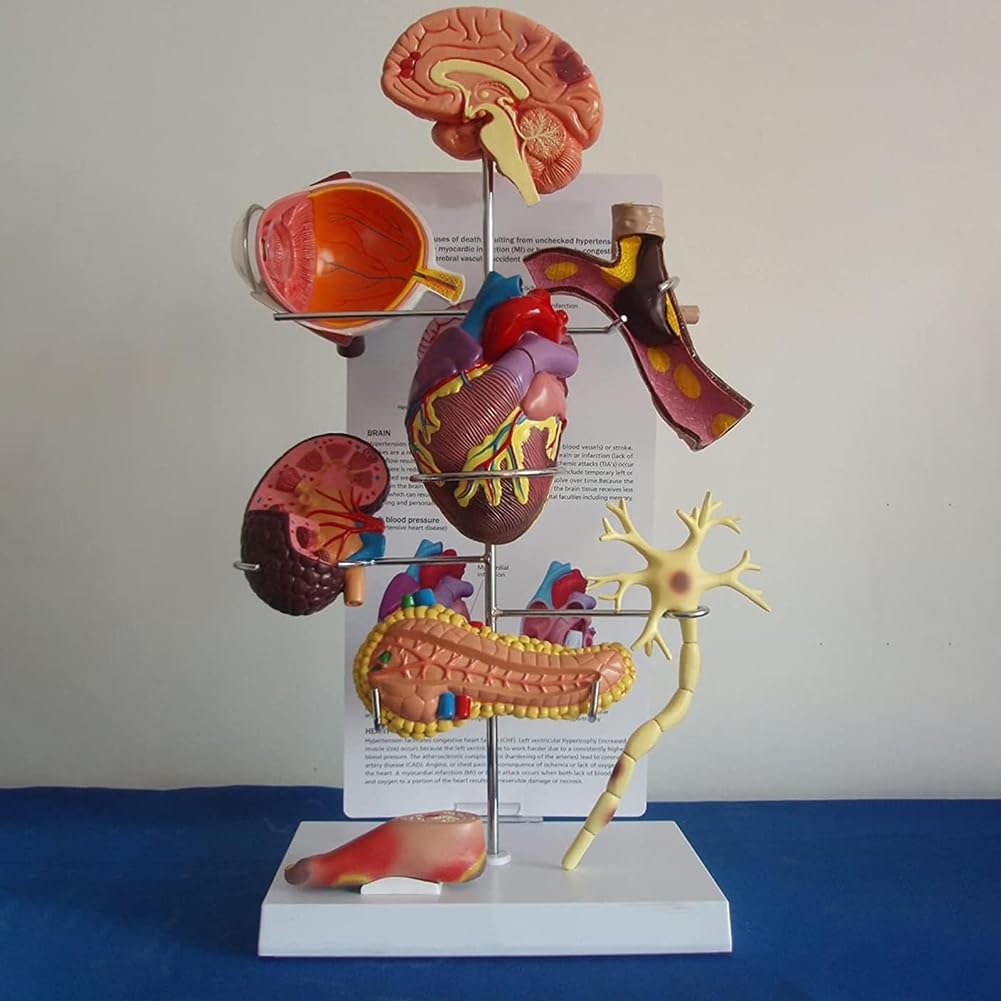 Modèle médical de diabète Modèle Anatomique de diabète Organe Humain Amovible Complications anatomiques du diabète Modèle d'affichage pour la médecine