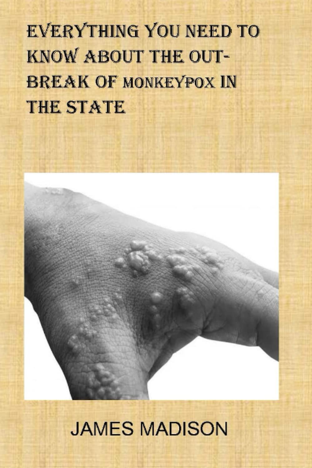Everything You Need To Know About The Outbreak Of Monkeypox In The State: Simple Tips On How To Control The Widespread Of Monkey Pox In The State