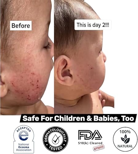 Miniatura 5 de Loma Lux Nuevo Eczemol OTC Spray natural y sin picaduras hipocloroso para eccema, heridas, quemaduras, cortes, irritación de la piel, dermatitis por