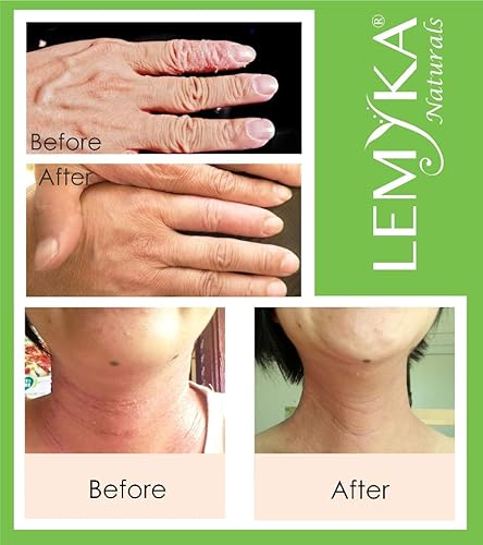 Miniatura 3 de LEMYKA Eczema Flare Defense Crema calmante natural - Paquete de 3 unidades, para bebés, niños y adultos con eccema (dermatitis atópica), parches