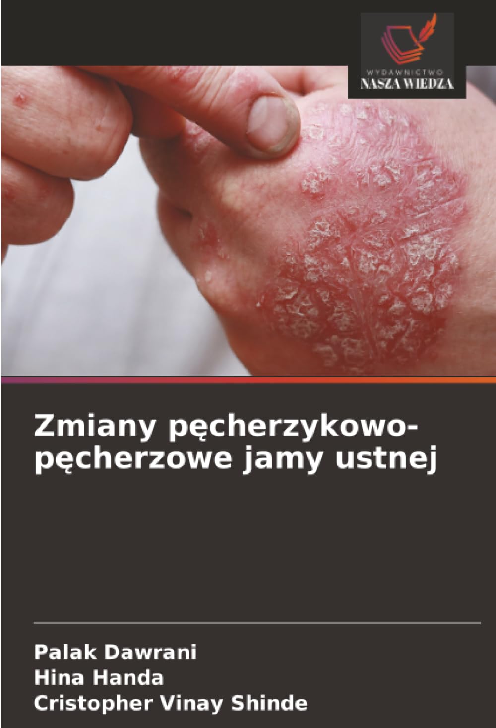 Zmiany p¿cherzykowo-p¿cherzowe jamy ustnej