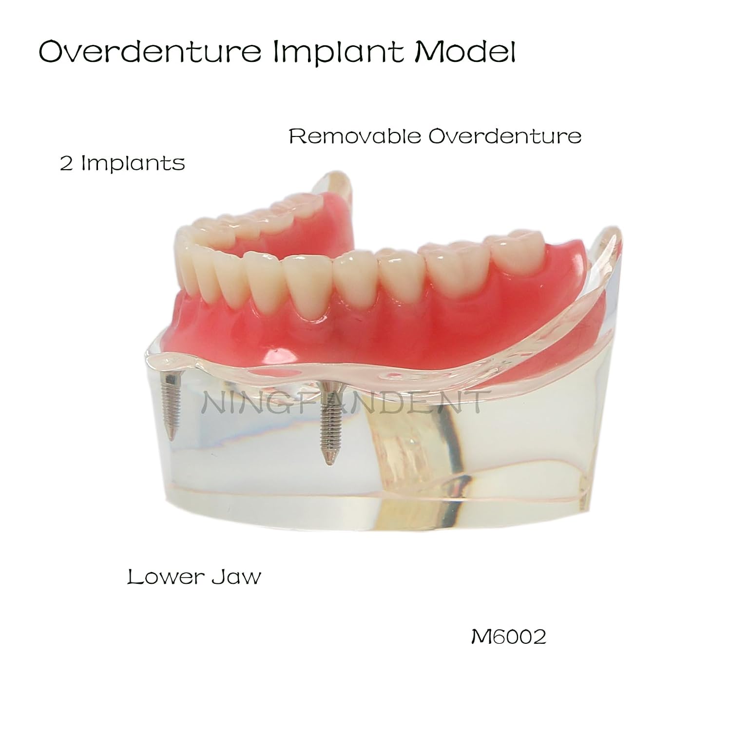 Dental Implant Model, Lower Jaw Overdenture, Removable Overdenture, with 2 Implants,M6002