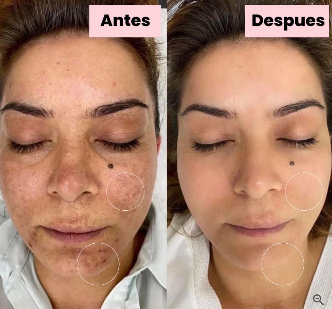 Generic Tonico Despigmentante LB *Elimina pecas, barros, paños, melasma*