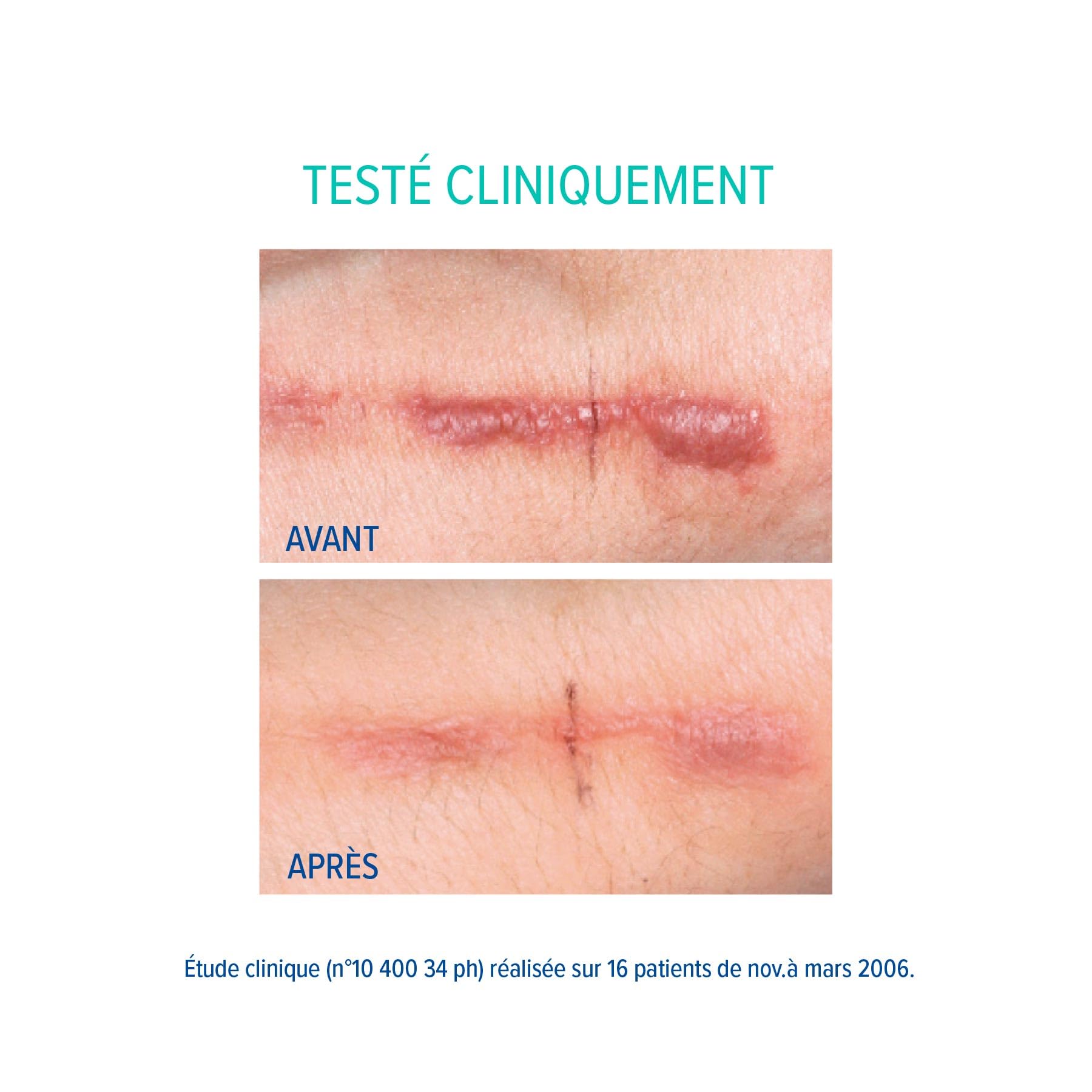 EPITACT | Protection en Silicone Cicatrices Chéloïdes et Hypertrophiques | Prévient et Améliore l’Aspect des Cicatrices Rouges, Gonflées, Boursouflées | Innovation Française