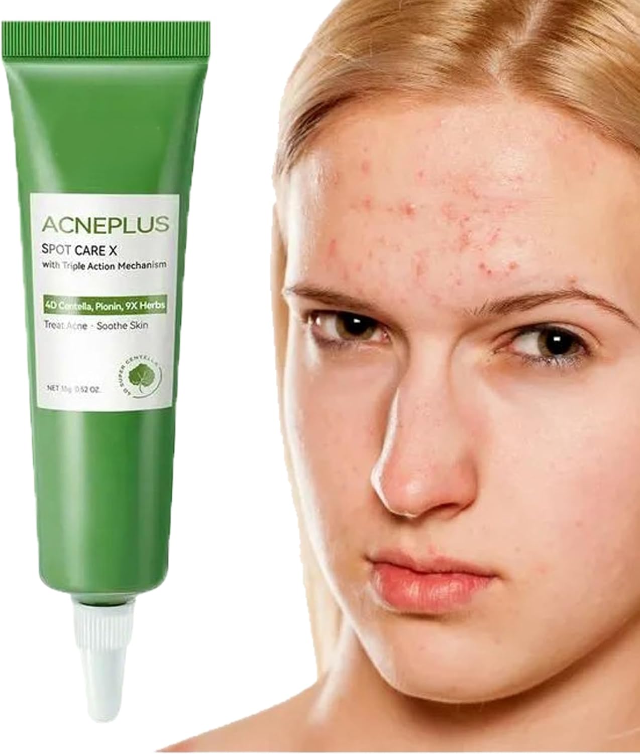 Anti Acne Face Cream,Gentle Acne Cream for Acne Prone Skin,Anti Acne