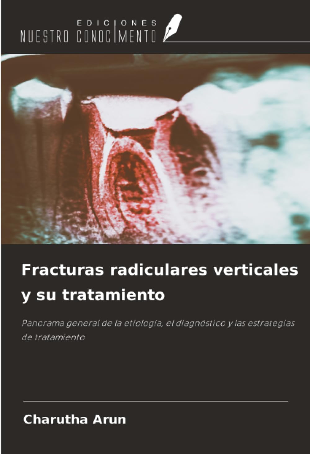 Fracturas radiculares verticales y su tratamiento: Panorama general de la etiología, el diagnóstico y las estrategias de tratamiento