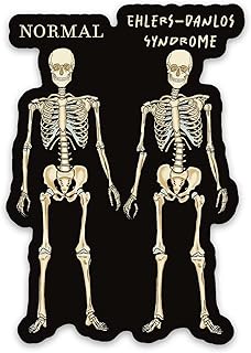 Ehlers-Danlos Syndrome Magnet, Skeleton Comparison Fridge Magnet, EDS Gift