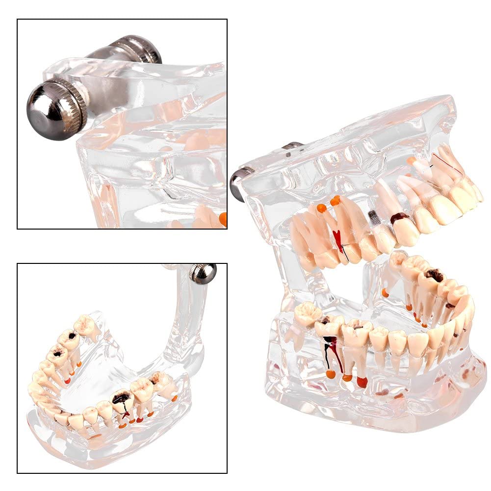 Walfront Modèle de Dents Amovibles, Transparent Dentaire Implant Disease Enseignement Étude Standard Dents Modèle Démonstration Pathologique