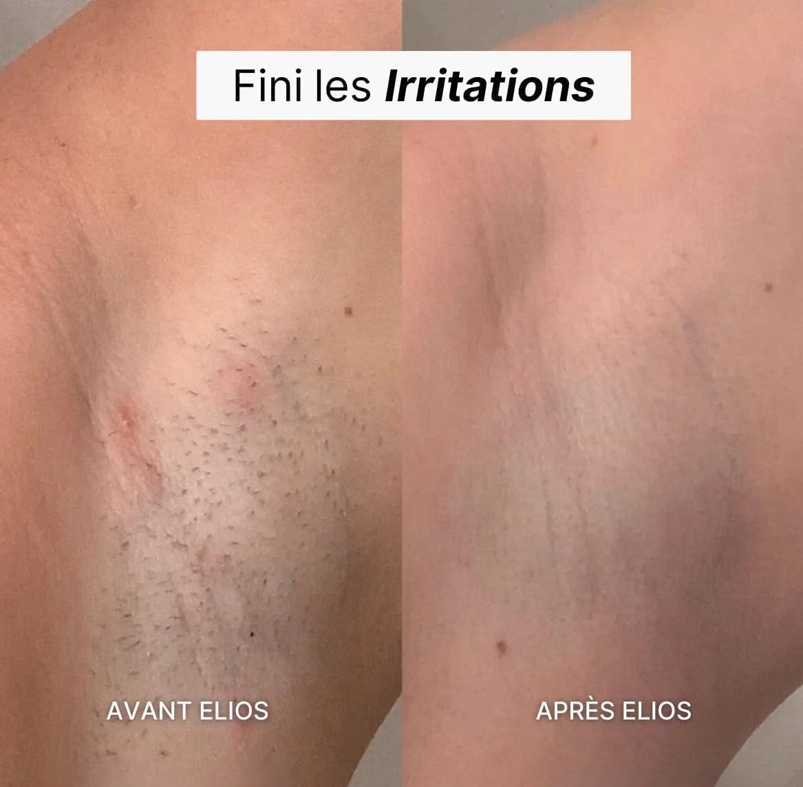 Rasoir Elios Femme 5 en 1, Elios Rasoir Femme,Épilateur Électrique avec Affichage LED Tondeuse Bikini 5 En 1 IPX7 Étanche Pour Bikini, Aisselles, Jambes, Ne