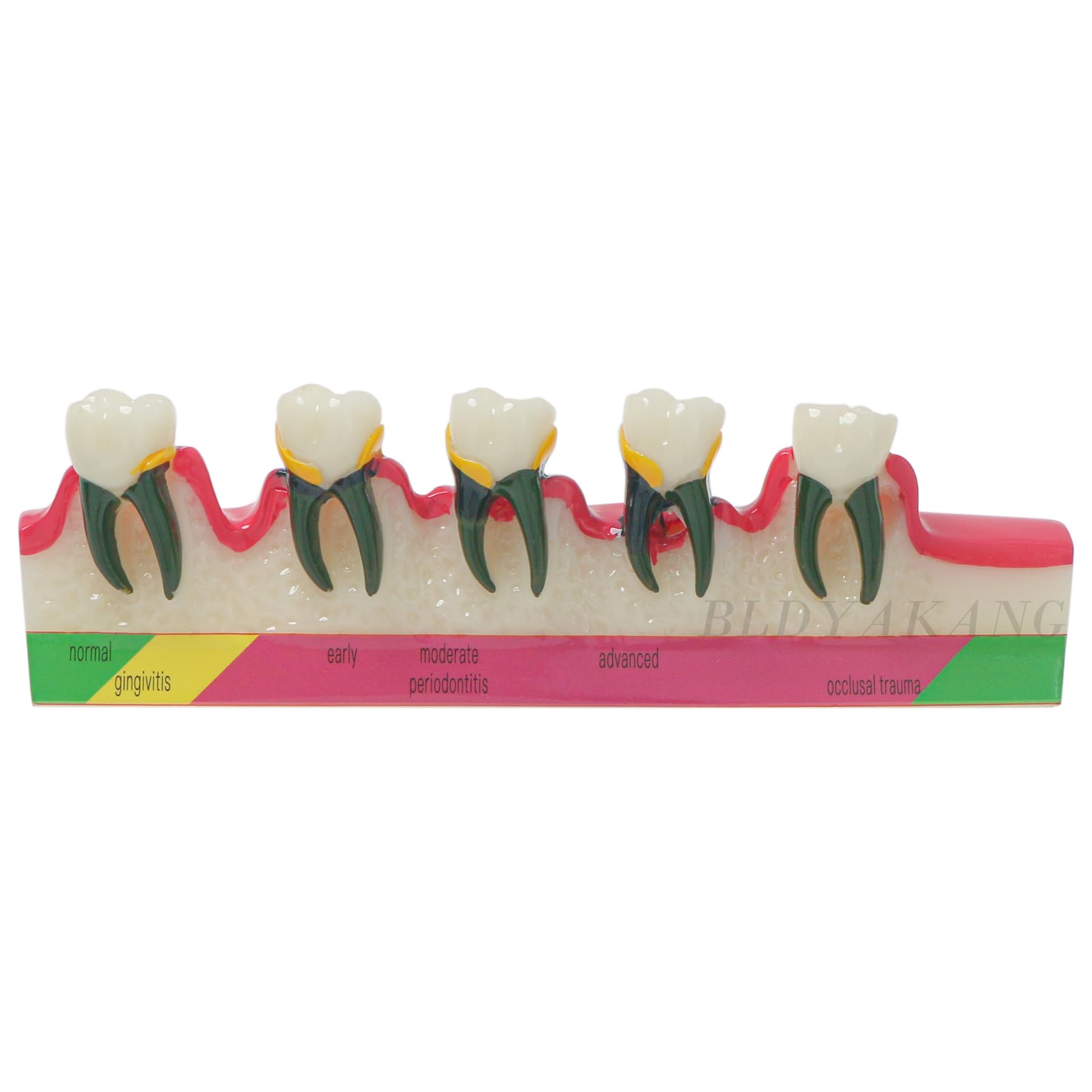 Dental Typodont Periodontal Disease Dental Caries Developing Model Dental Teeth Model for Dental Tooth Anatomy Study Doctor-Patient and Oral Care Education (M4029 Periodontal Disease Teeth Model)