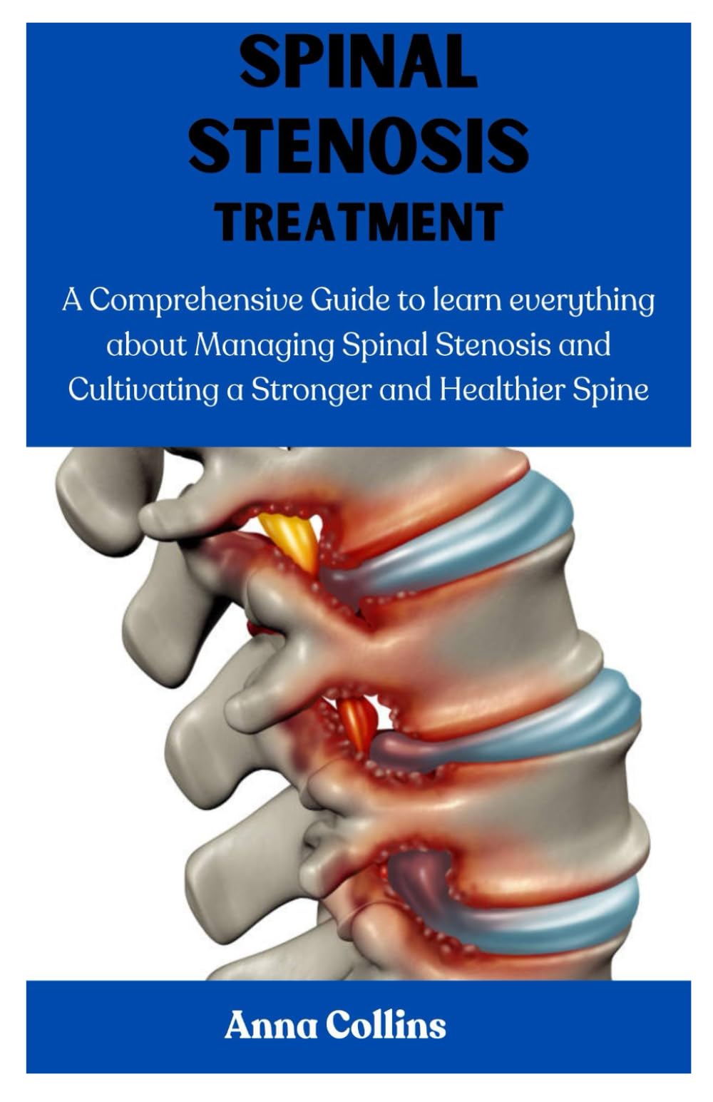 SPINAL STENOSIS TREATMENT: A Comprehensive Guide to learn everything about Managing Spinal Stenosis and Cultivating a Stronger and Healthier Spine