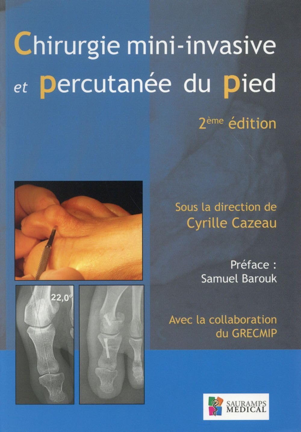CHIRURGIE MINI-INVASIVE PERCUTANEE DU PIED 2ED (0000)