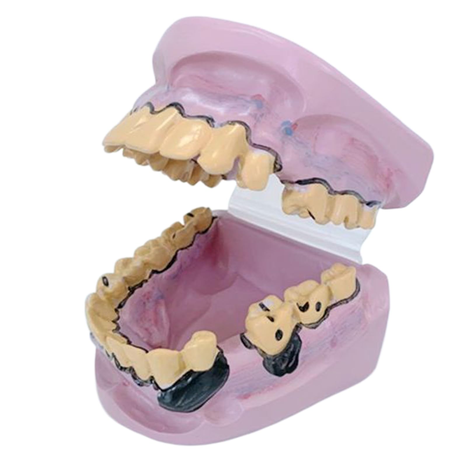 YRQMGSF Dental Pathology Model Cavities and Dental Caries Model Dental Anatomy Education Tooth Model for Dental Display