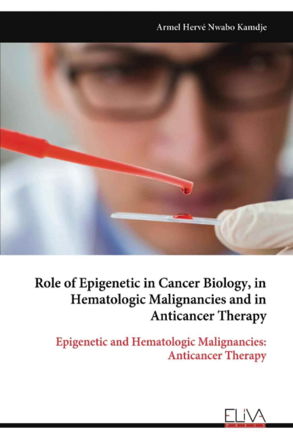 Role of Epigenetic in Cancer Biology, in Hematologic Malignancies and in Anticancer Therapy: Epigenetic and Hematologic Malignancies: Anticancer Therapy
