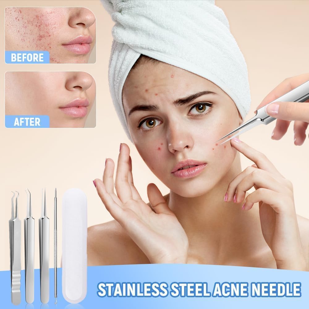 Kit di strumenti per l'estrazione di punti neri di grado medico, pinzette professionali in acciaio inox per rimuovere acne e punti neri, strumenti di estrazione per estetisti (9 pezzi (con lente