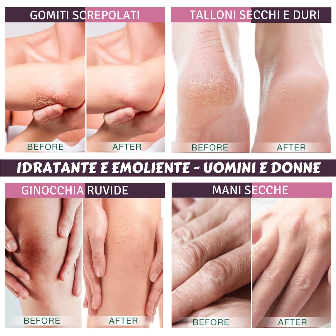 Urea 20% Crema Cheratolitica 100ml – Pelle sogetta a Psoriasi, Dermatite Atopica, Cheratosi, Ipercheratosi - Pelle Molto Secca, Desquamata e Fissurata, Prurito, Irritazioni Superficiali
