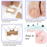 Vista 5 de Parche de corrección de uñas encarnadas, 50 calcomanías de uñas encarnadas sin pegamento para uñas encarnadas curvadas para el cuidado de los pies