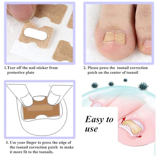 Miniatura 5 de Parche de corrección de uñas encarnadas, 50 calcomanías de uñas encarnadas sin pegamento para uñas encarnadas curvadas para el cuidado de los pies,