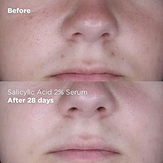 Skin Republic Salicylic Acid 2% Serum. Clinically Proven to Reduce Pimples in 7 Days. Made in Europe.