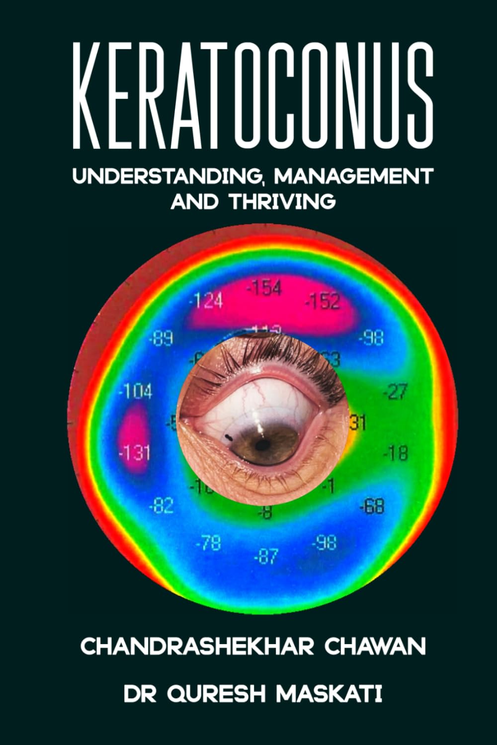 Keratoconus: Understanding, Managing, and Thriving,