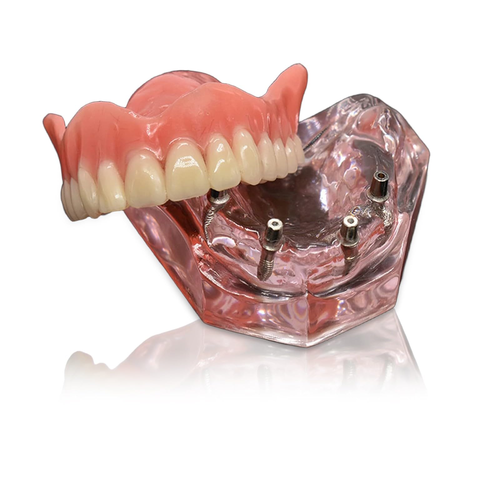 Modelo de dientes para implantes dentales tipodonto, rosa transparente, restauración de implantes dentales tipodonto, sobredentadura, 4 implantes, superior, demostración para estudio y enseñanza.