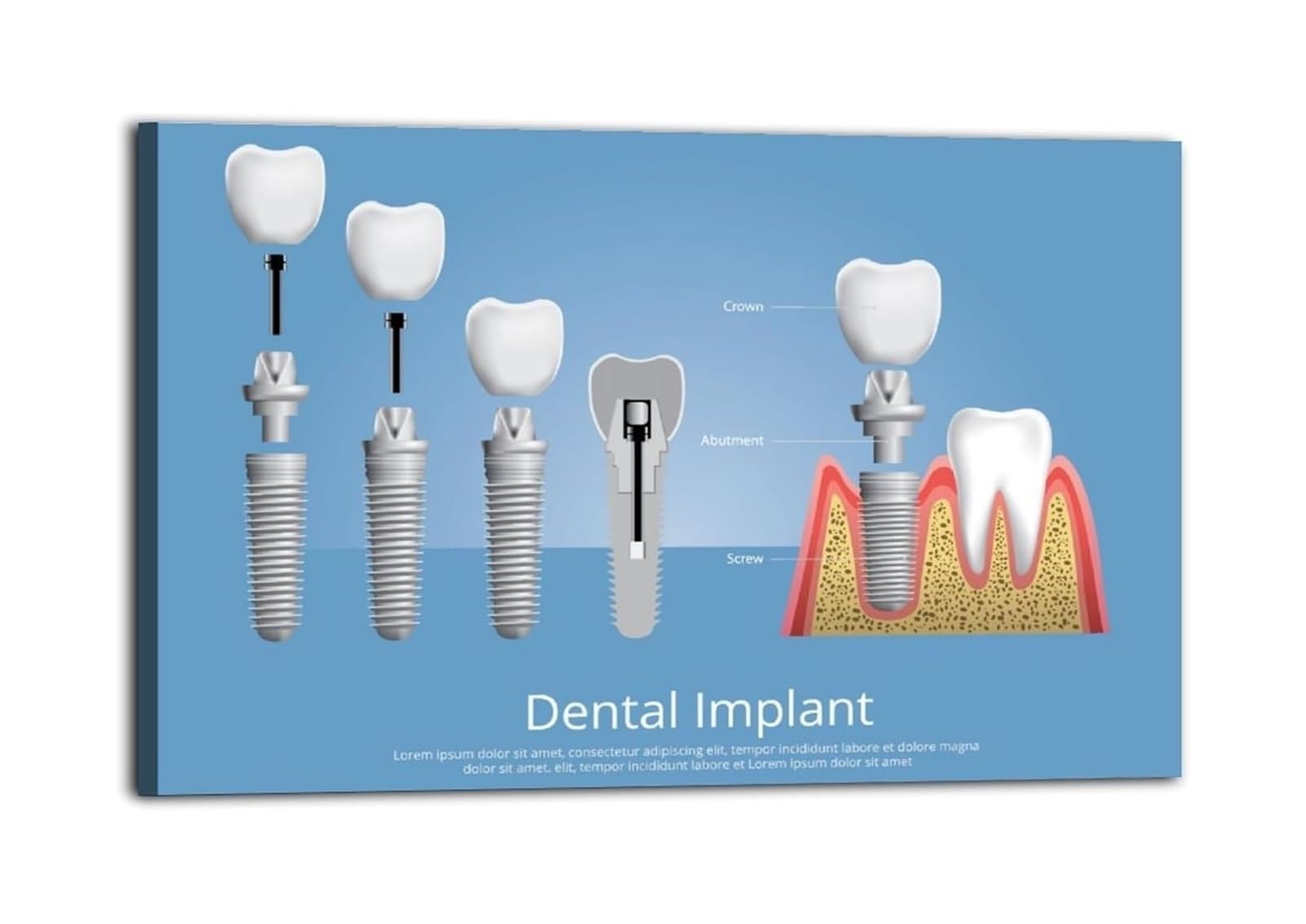 RNUMLIGH The Implant Guide Poster, Comprehensive Anatomy and Surgery Diagram, Office Decor for Professionals(Framed,12X18inch(30X45cm))