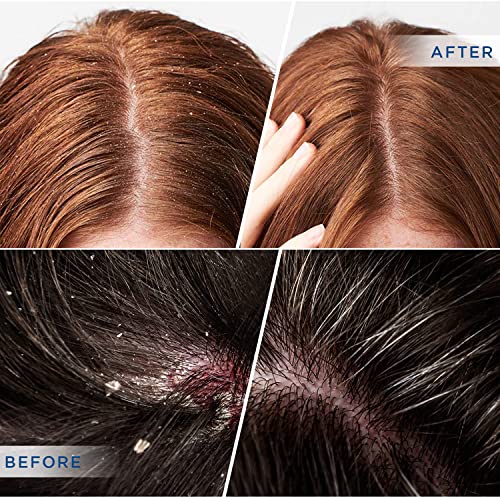 Derphea Psoriasis Shampoo, Folliculitis Shampoo, Seborrheic Dermatitis Shampoo, Dry Scalp Shampoo, Itchy Scalp Shampoo, Relief Dry, Itchy, Safe Ingredients For All Skin Types #TOP4