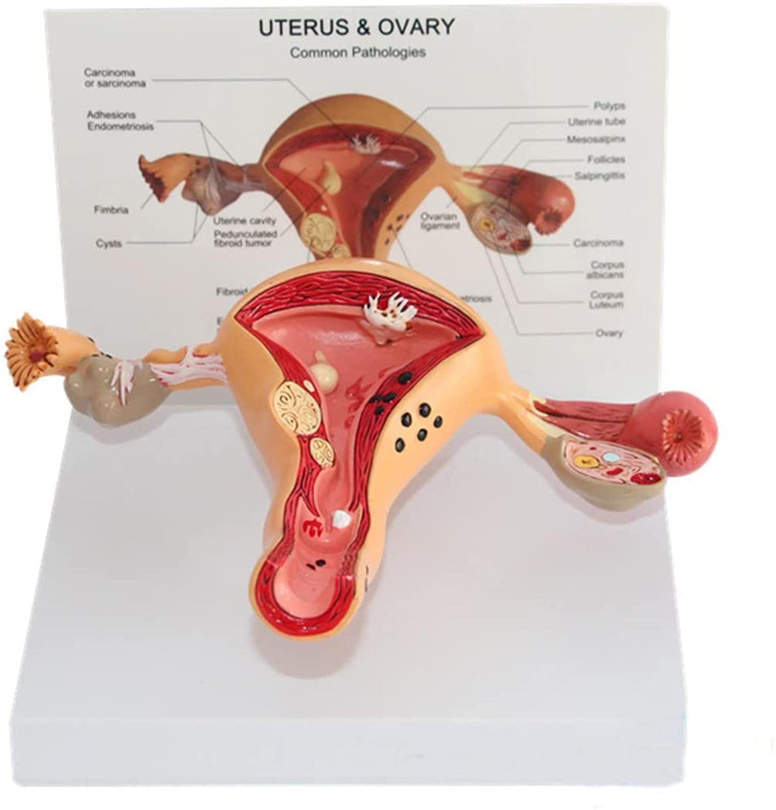 Pathological Uterus Model, Uterus Anatomical Model Uterine And Ovarian Lesions Model Female Reproductive System Model Doctors