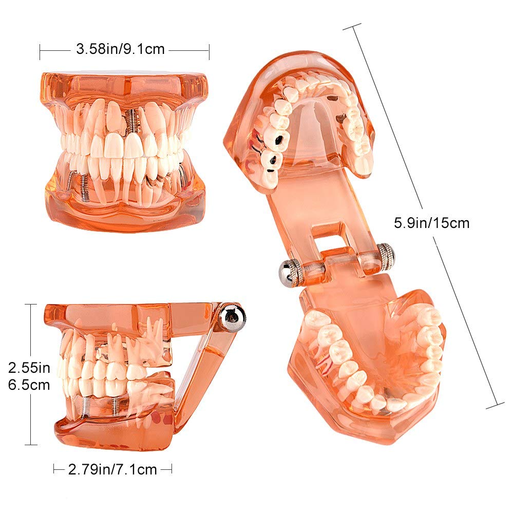 Zahnmodell Gebiss Modell zum Unterrichten Zahndegeneration Demonstrationsstudie Orange Modell Zahnersatz Studium Zahnverfall Lehrmodell Dentalmodell für Studenten und Lehrkräfte