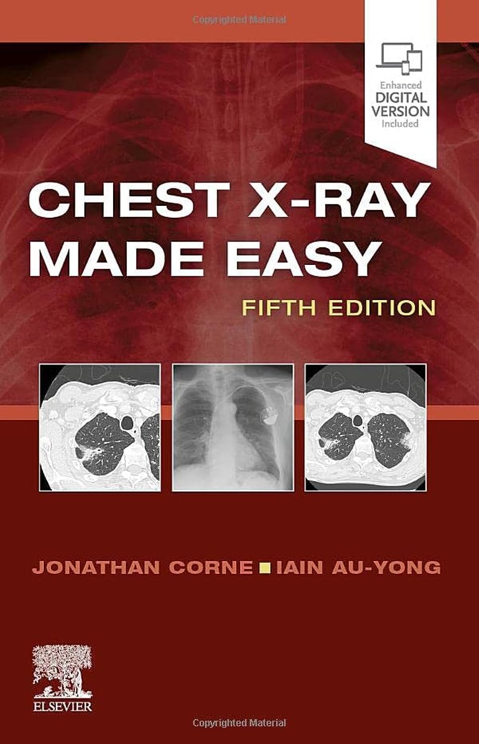 Chest X-​Ray Made Easy