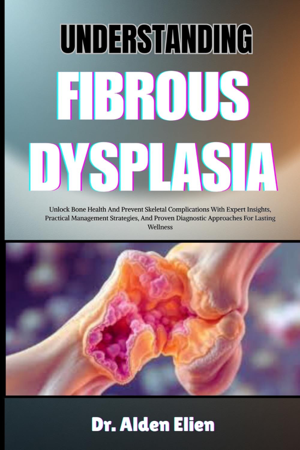 UNDERSTANDING FIBROUS DYSPLASIA: Unlock Bone Health And Prevent Skeletal Complications With Expert Insights, Practical Management Strategies, And Proven Diagnostic Approaches For Lasting Wellness