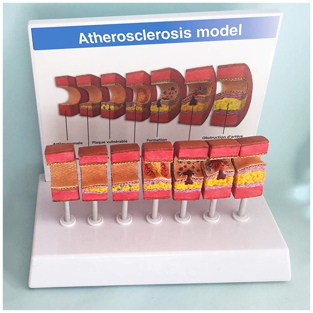 Anatomisches Modell der Arterie - Anatomisches Gefäß-Atherosklerose-Thrombus-Gefäß-Modell Modell der menschlichen Arterie - für das Studien-Display Lehre Medizinisches Modell