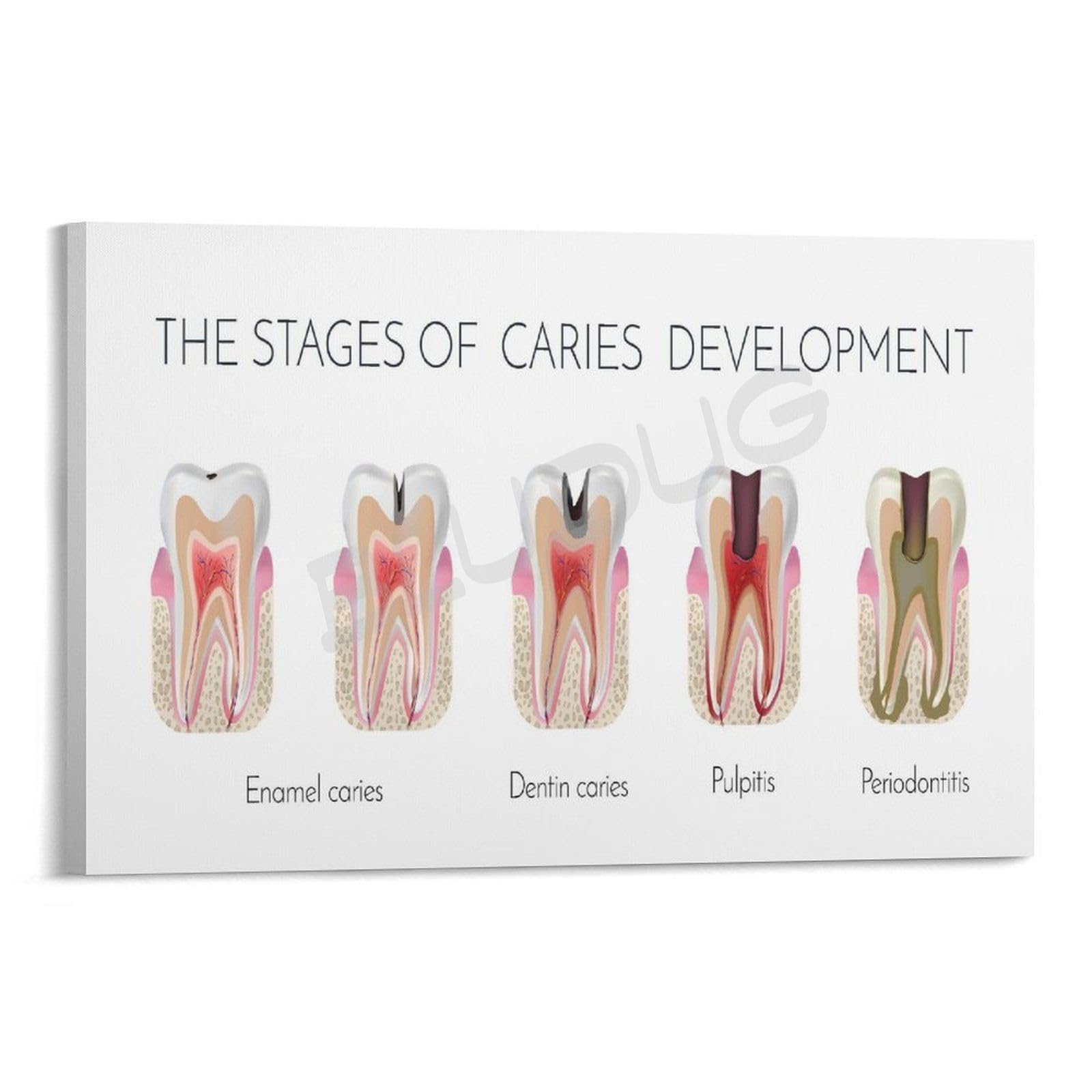 BLUDUG Dental Infographic Poster Posters of The Stages of Caries Formation Canvas Painting Wall Art Poster for Bedroom Living Room Decor16x24inch(40x60cm)