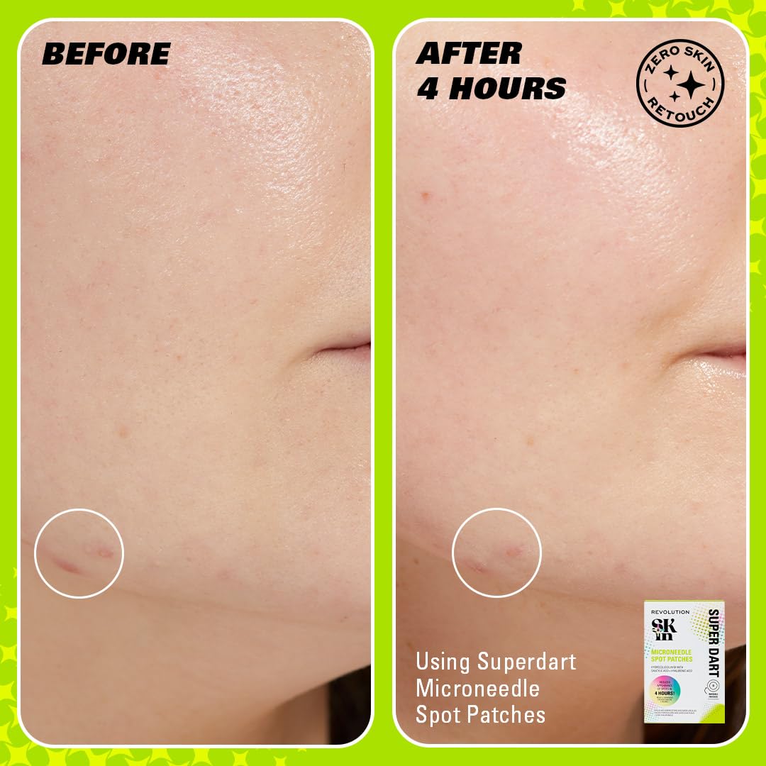 Revolution SKin, super dart Microneedle Spot Patches, plastry na pryszcze z kwasem salicylowym i hialuronowym, wegańskie i wolne od okrucieństwa, 9 plastrów