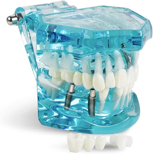 Den_tal - Modelo de implante de enfermedad transparente, demostración patológica de dientes estándar, herramienta de aprendizaje de enseñanza para